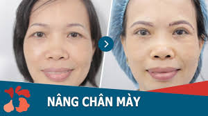 Nâng chân mày - Hình ảnh minh họa